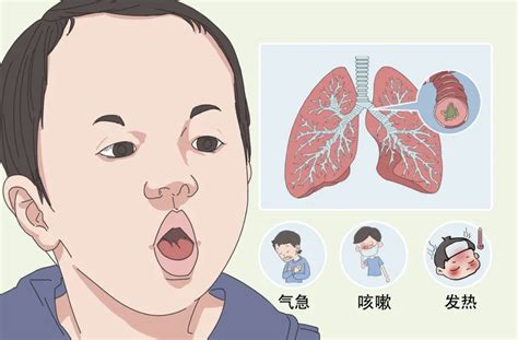 小孩子咳嗽|宝宝一直咳嗽，是不是得了「百日咳」？